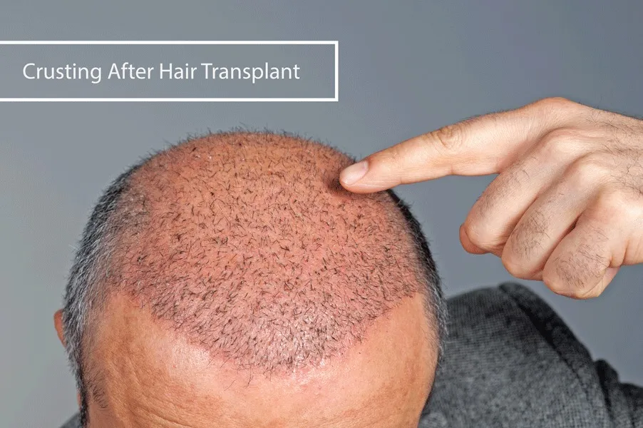 Wann und Wie kann ich die Verkrustung nach einer Haartransplantation Entfernen?