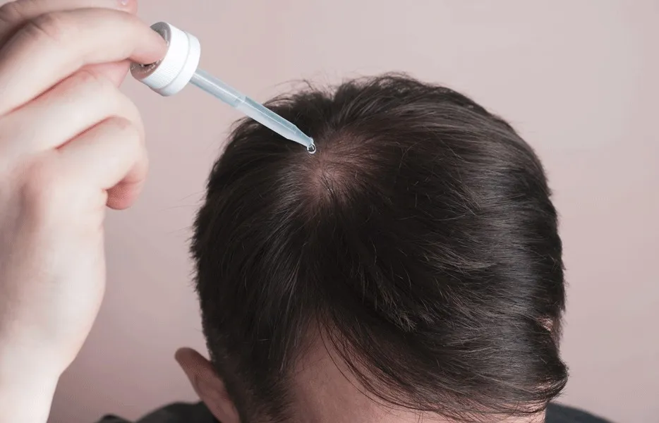 Müssen Sie nach einer Haartransplantation Minoxidil Einnehmen?